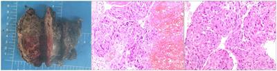 Testicular choriocarcinoma with pelvic and pulmonary metastases: a case report